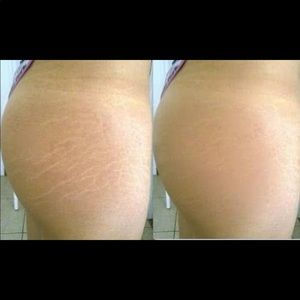 Stretch mark - dark spots removed